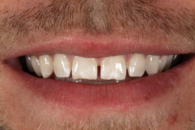 Porcelain Veneers: Zac - Before