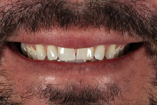 Porcelain Veneers: Tony - Before
