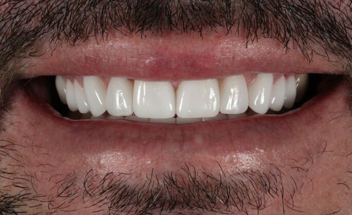 Porcelain Veneers: Tony - After