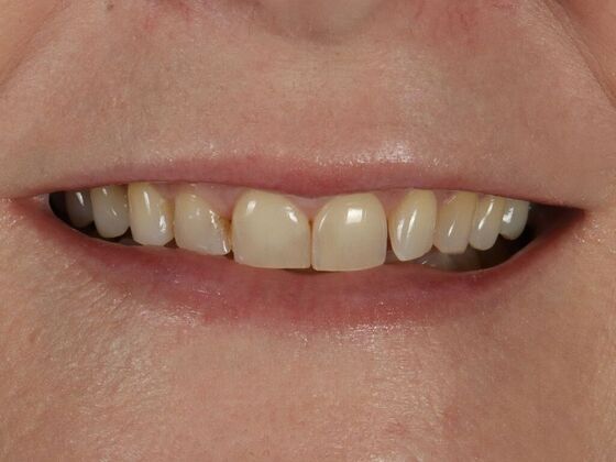 Porcelain Veneers: LeAnn - Before