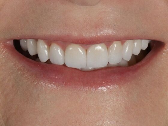 Porcelain Veneers: LeAnn - After