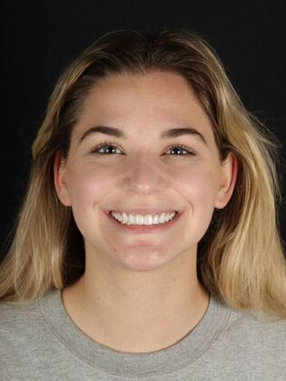 Porcelain Veneers Madison - After