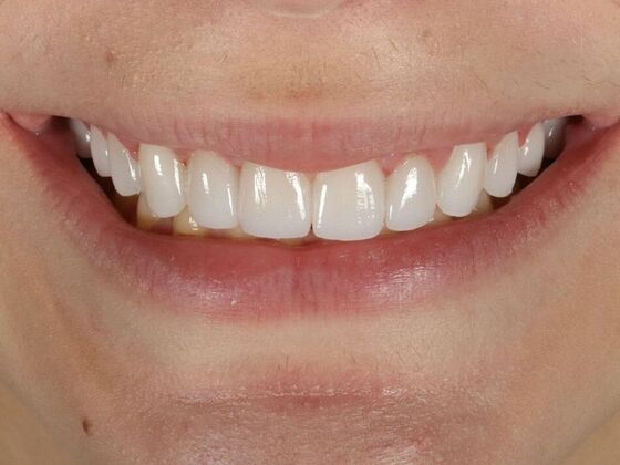 Porcelain Veneers: Madison - After