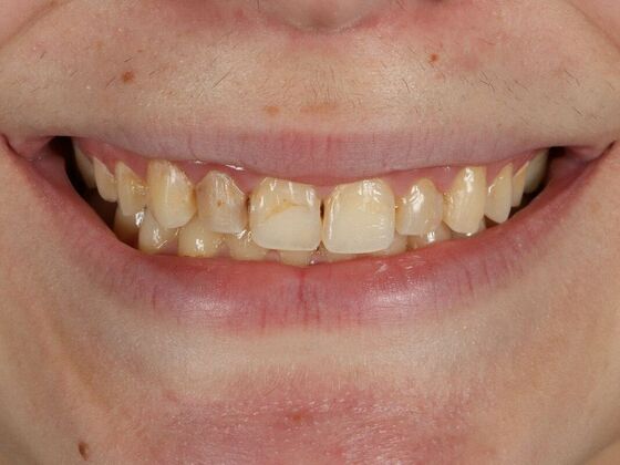 Porcelain Veneers: Madison - Before