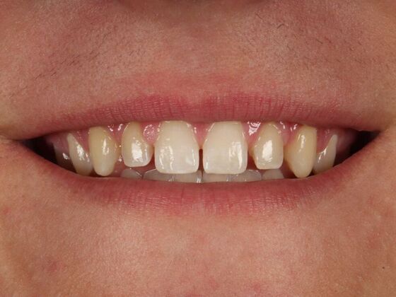 Porcelain Veneers: Luke - Before