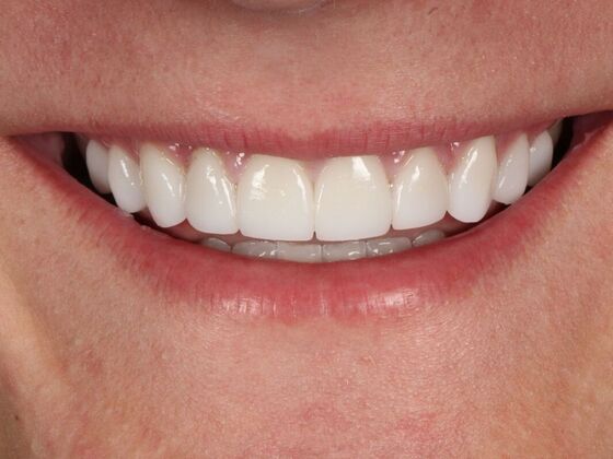 Porcelain Veneers: Luke - After