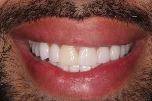 Full Mouth Rehabilitation: Eric - Before