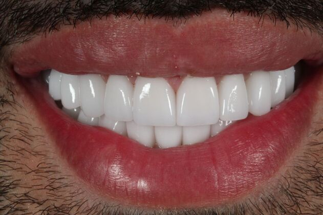 Full Mouth Rehabilitation: Eric - After