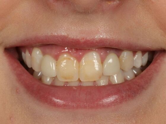 Dental Implants: Zoe - Before