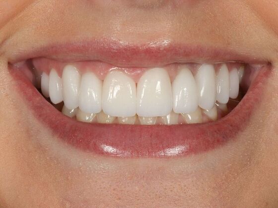 Dental Implants: Zoe - After