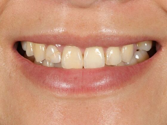 Dental Implants: Cathy - Before