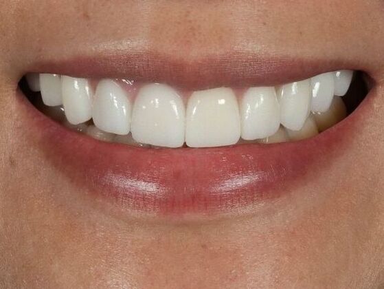 Dental Implants: Cathy - After