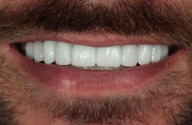 Dental Implants: Ty - After