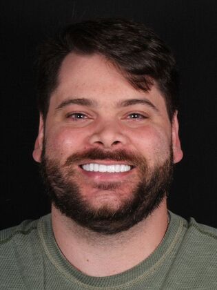 Dental Implants Ty - After