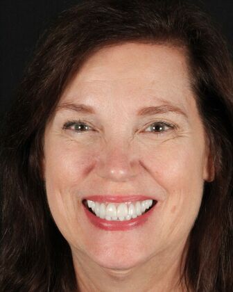 Dental Implants Paula - After