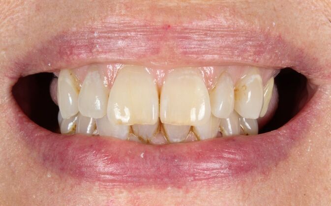 Dental Implants: Paula - After