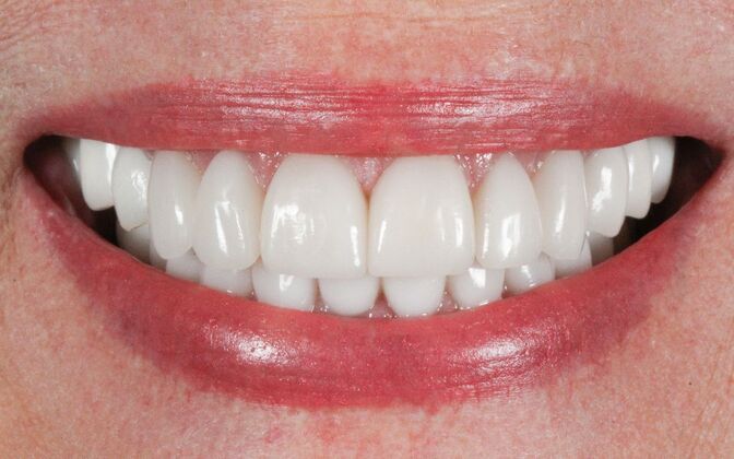 Dental Implants: Paula - Before