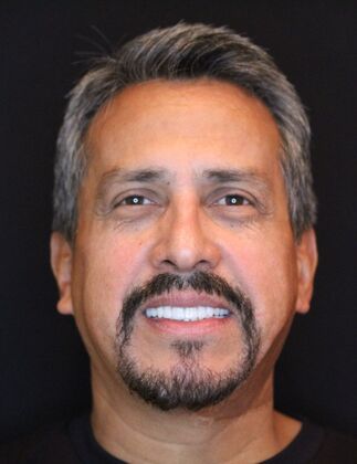 Dental Implants: Oscar - After