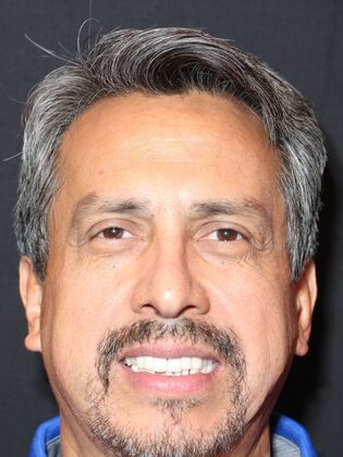 Dental Implants: Oscar - Before