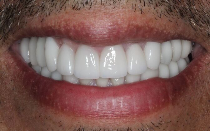 Dental Implants: Oscar - After