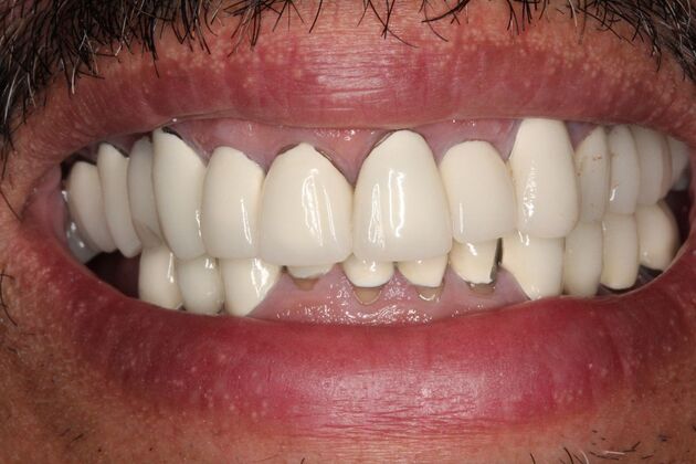 Dental Implants: Oscar - Before