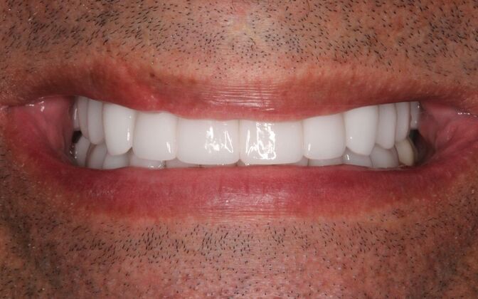 Full Mouth Rehabilitation: Mark - After