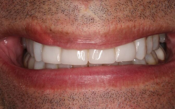 Full Mouth Rehabilitation: Mark - Before