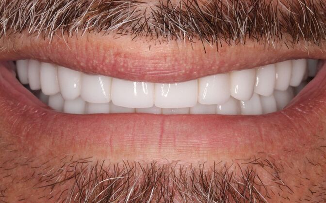 Full Mouth Rehabilitation: John - After