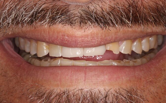Full Mouth Rehabilitation: John - Before