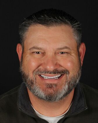 Full Mouth Rehabilitation John - After