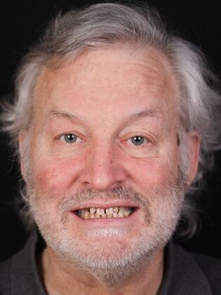 Full Mouth Rehabilitation Barton - Before