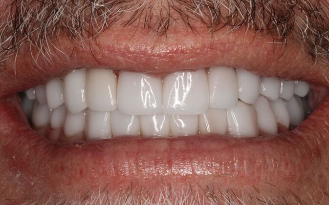 Full Mouth Rehabilitation: Barton - After