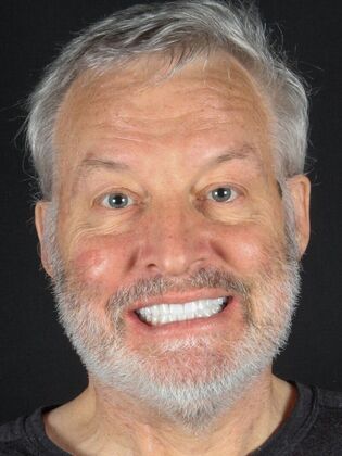 Full Mouth Rehabilitation Barton - After