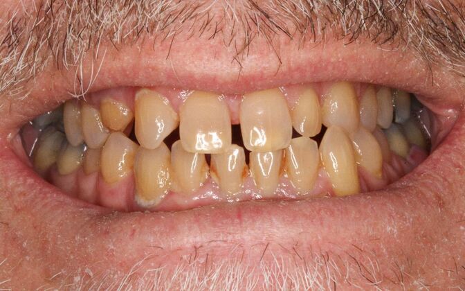 Full Mouth Rehabilitation: Barton - Before