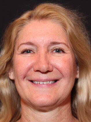 Full Mouth Rehabilitation Stephanie - Before