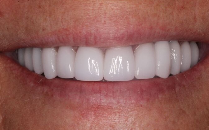 Full Mouth Rehabilitation: Stephanie - After