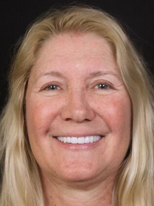 Full Mouth Rehabilitation Stephanie - After