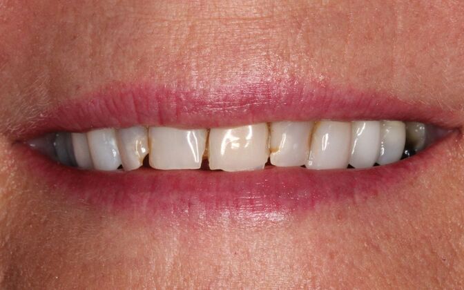 Full Mouth Rehabilitation: Stephanie - Before