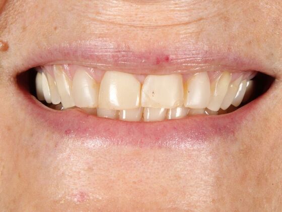 Full Mouth Rehabilitation: Carol - Before