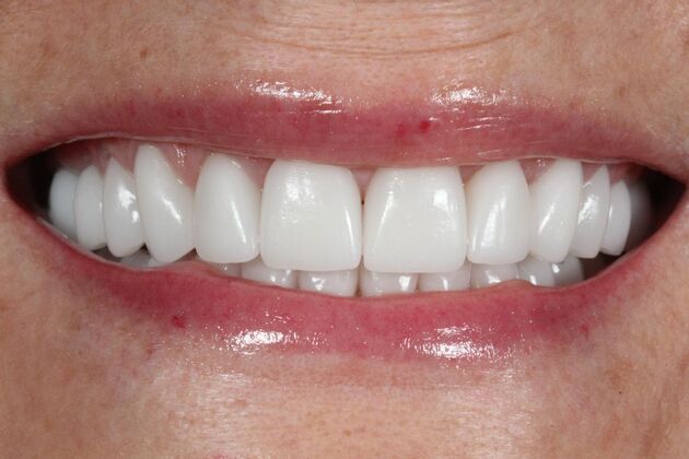 Full Mouth Rehabilitation: Carol - After