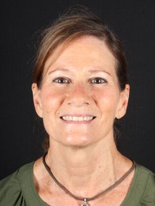 Full Mouth Rehabilitation Carol - Before