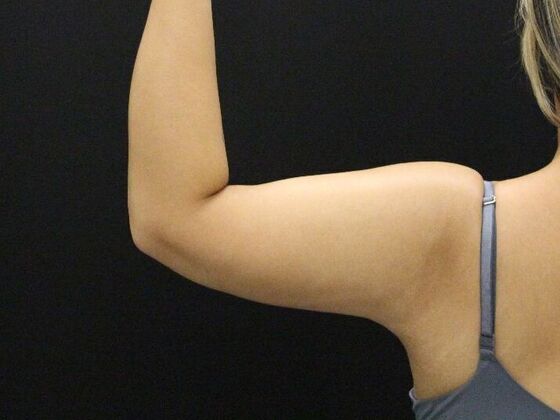 Arm Lift & Reduction: Case 11 - After