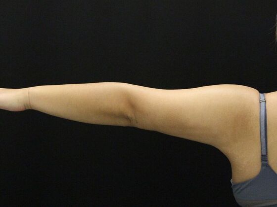 Arm Lift & Reduction: Case 11 - After