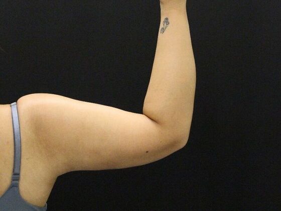 Arm Lift & Reduction: Case 11 - After