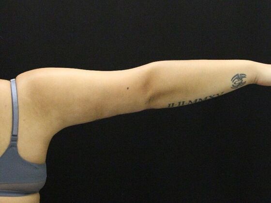 Arm Lift & Reduction: Case 11 - After