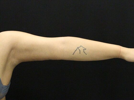 Arm Lift & Reduction Case 11 - After