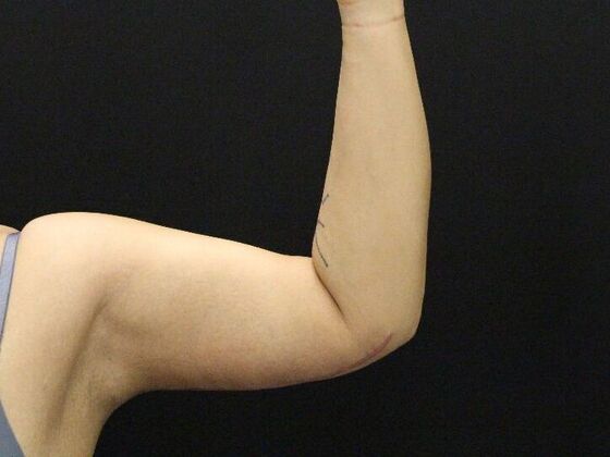 Arm Lift & Reduction: Case 11 - After