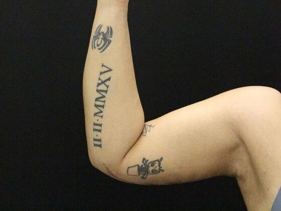 Arm Lift & Reduction: Case 11 - After