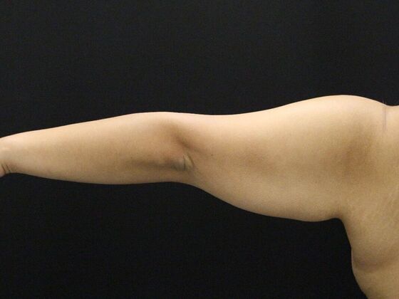 Arm Lift & Reduction: Case 11 - Before