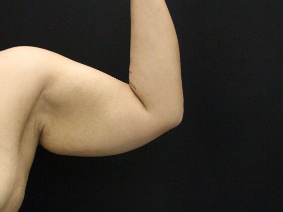 Arm Lift & Reduction: Case 11 - Before